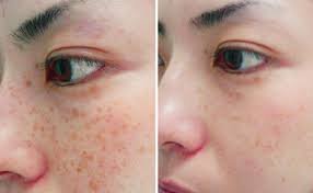 PIGMENTATION LASER